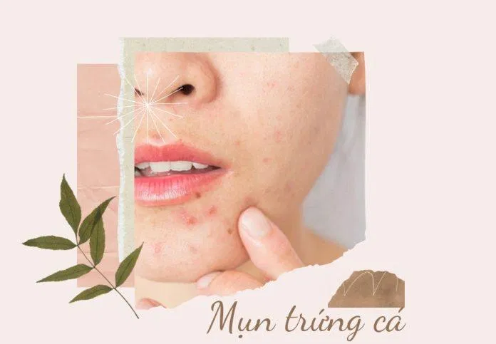 Mụn trứng cá quang miệng là tình trạng mụn phổ biến và dễ điều trị nhất (Ảnh: Internet).