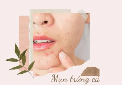 Mụn trứng cá quang miệng là tình trạng mụn phổ biến và dễ điều trị nhất (Ảnh: Internet).