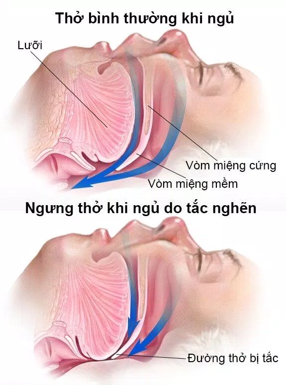 Đường thở bị tắc nghẽn khi nằm ngửa (Ảnh: Internet) Đường thở bị tắc nghẽn khi nằm ngửa (Ảnh: Internet)
