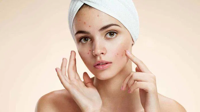 TOP sữa rửa mặt cho da dầu mụn nhạy cảm: làm sạch sâu, kiềm dầu hiệu quả Camellia Sinensis Leaf Extract Centella Asiatica Extract Ceramides Citric Acid Coptis Chinensis Root Extract Da dầu mụn là da như thế nào Da nhạy cảm là da như thế nào glycerin hyaluronic acid Lactic Acid lauric acid Myristic Acid Niacinamide Phytosphingosine Propylene Glycol Rubus Idaeus Fruit Extract Salicylic Acid Sữa rửa mặt Cerave Foaming Facial Cleanser Gel Moussant sữa rửa mặt Cetaphil Gentle Skin Cleanser sữa rửa mặt cho da dầu mụn nhạy cảm Sữa rửa mặt innisfree Green Tea Foam Cleanser Sữa rửa mặt La RoChe Posay Effaclar Deep Foaming Cream Sữa rửa mặt Laneige Multi Deep Clean Cleanser Sữa rửa mặt Neutrogena Deep Clean Facial Cleanser Sữa rửa mặt Simple Kind To Skin Refreshing Facial Wash Sữa rửa mặt Skin1004 Madagascar Centella Ampoule Foam Sữa rửa mặt Some By Mi AHA BHA PHA 30 Days Miracle ACNE Clear Foam Tại sao chúng ta dễ nhầm lẫn giữa da dầu mụn và da nhạy cảm TOP 10 sữa rửa mặt cho da dầu mụn nhạy cảm mà bạn không nên bỏ qua vitamin B5 vitamin E