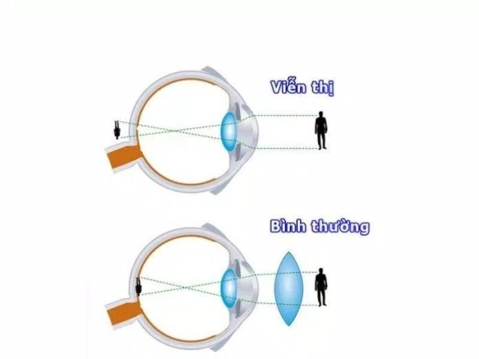 Mắt viễn thị so với mắt bình thường (Ảnh: Internet)
