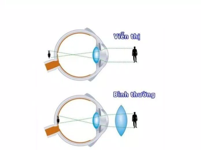Mắt viễn thị so với mắt bình thường (Ảnh: Internet) Mắt viễn thị so với mắt bình thường (Ảnh: Internet)