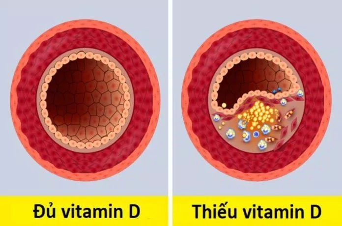 Dấu hiệu thiếu vitamin D (Ảnh: Internet)