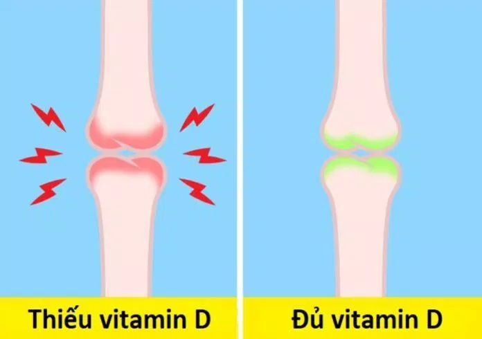 Dấu hiệu thiếu vitamin D (Ảnh: Internet)