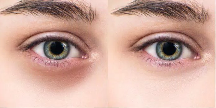 Có vô số cách để làm giảm quầng thâm mắt(Nguồn: Internet)