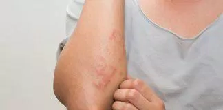 Viêm da cơ địa là bệnh không hiếm gặp và khiến người bệnh rất khó chịu (Ảnh: Internet)