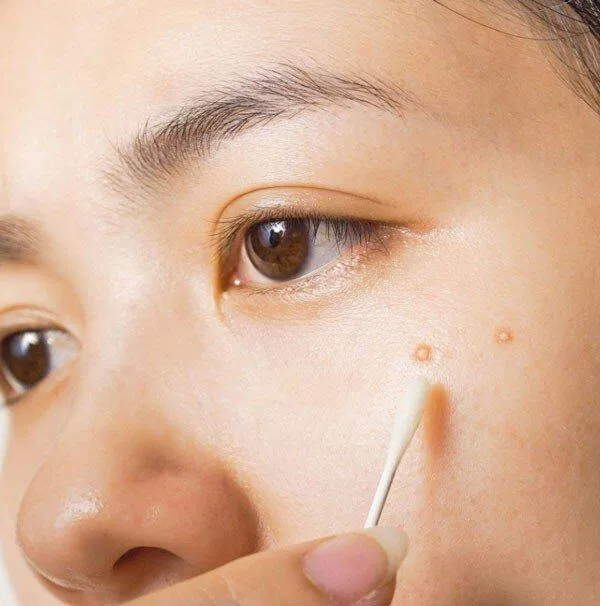 Xử lý mụn chai đúng cách để không gây viêm lây lan(Ảnh: internet)