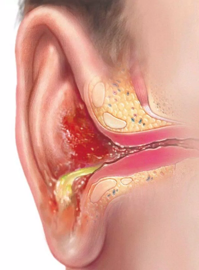 Nước đọng lại trong tai lâu dài có thể dẫn đến viêm nhiễm (Ảnh: Internet)