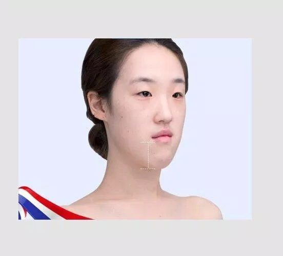 Cằm quá dài làm mất cân đối gương mặt(Nguồn: Internet)