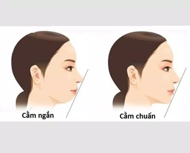 Cằm ngắn làm mất đi sự cân đối của gương mặt( Nguồn: Internet)