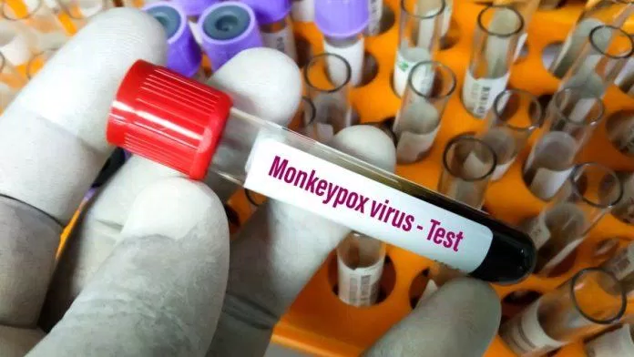 Bệnh đậu mùa khỉ có thể ảnh hưởng tất cả mọi người không phân biệt giới tính (Ảnh: Internet) Bệnh đậu mùa khỉ có thể ảnh hưởng tất cả mọi người không phân biệt giới tính (Ảnh: Internet)
