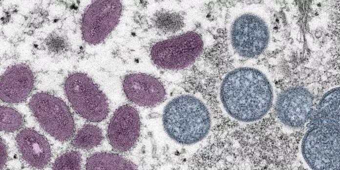 Virus gây bệnh đậu mùa khỉ nhìn dưới kính hiển vi (Ảnh: Internet)