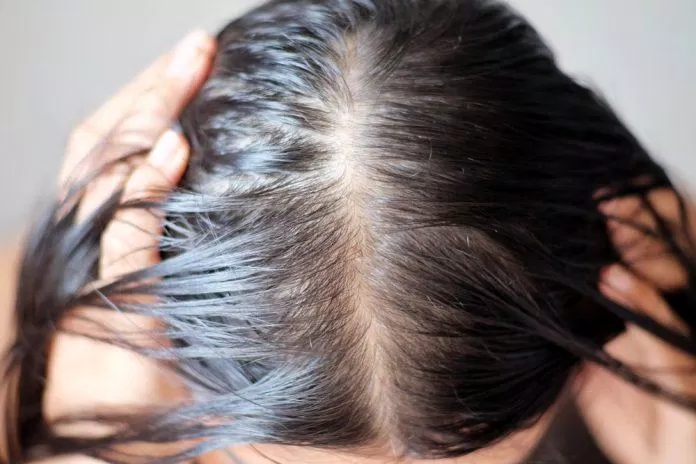 Nguyên nhân gây nên mái tóc bết dính(Nguồn: Internet)