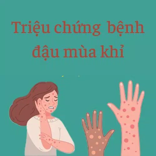 Bệnh đậu mùa khỉ lây qua tiếp xúc trực tiếp (Ảnh: Internet) Bệnh đậu mùa khỉ lây qua tiếp xúc trực tiếp (Ảnh: Internet)
