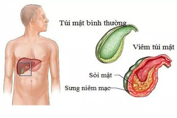 Nhiều người bị sỏi mật mà không biết bản thân cũng có thể bị ung thư túi mật (Nguồn: Internet) Nhiều người bị sỏi mật mà không biết bản thân cũng có thể bị ung thư túi mật (Nguồn: Internet)