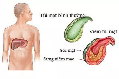 Nhiều người bị sỏi mật mà không biết bản thân cũng có thể bị ung thư túi mật (Nguồn: Internet) Nhiều người bị sỏi mật mà không biết bản thân cũng có thể bị ung thư túi mật (Nguồn: Internet)