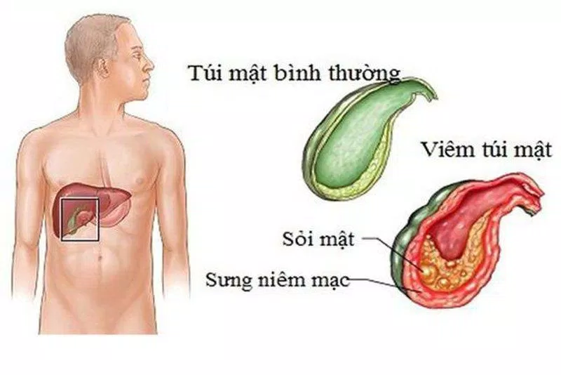 Nhiều người bị sỏi mật mà không biết bản thân cũng có thể bị ung thư túi mật (Nguồn: Internet)