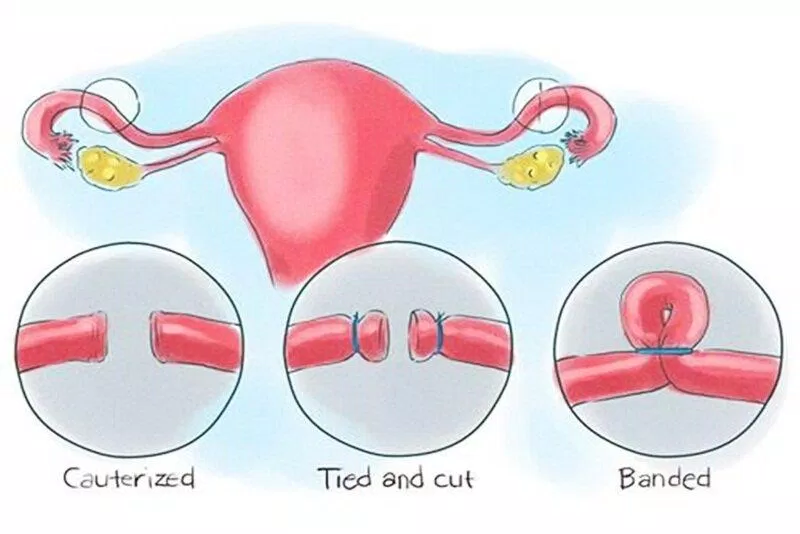 Thắt ống dẫn trứng (Ảnh: Internet)