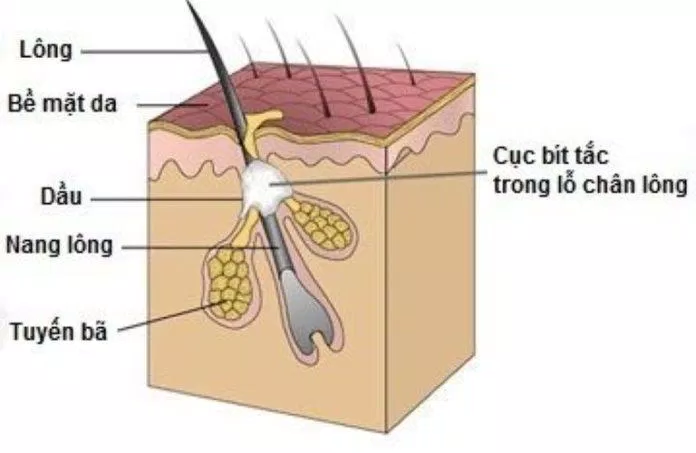 Hình ảnh minh họa cho bít tắc lỗ chân lông (nguồn:Internet)