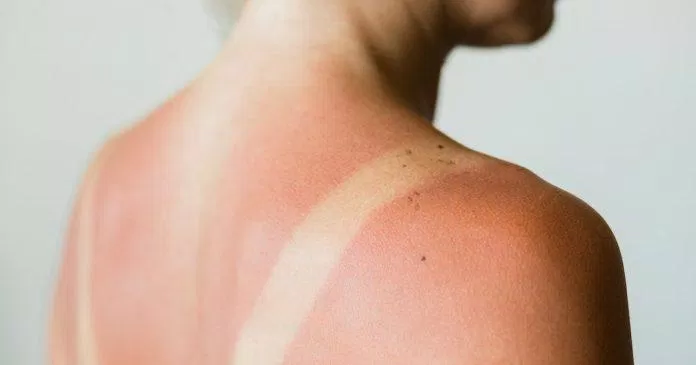 Bảo vệ da khỏi tình trạng cháy nắng (Ảnh: Internet)