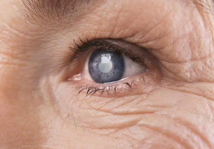 Đục thủy tinh thể là một vấn đề về mắt do biến chứng đái tháo đường (Ảnh: Internet)
