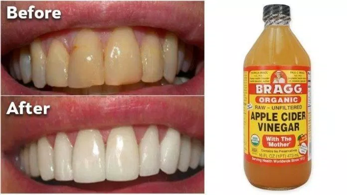 Giấm táo giúp trắng răng, hơi thở thơm (Nguồn: Internet).