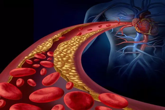 Cắt bỏ đường làm giảm mức độ lipid trong máu (Ảnh: Internet) Cắt bỏ đường làm giảm mức độ lipid trong máu (Ảnh: Internet)