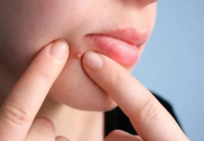 Đừng bao giờ tự nặn mụn tại nhà (Ảnh: Internet) Đừng bao giờ tự nặn mụn tại nhà (Ảnh: Internet)