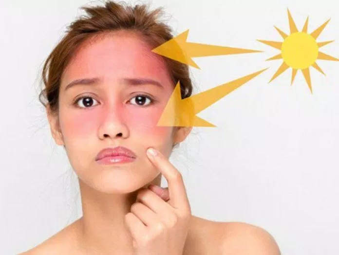 Tia UV là kẻ thù số một gây stress cho da (Ảnh: Internet)