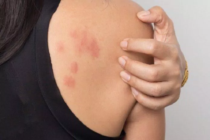 Căng thẳng khiến da bị kích ứng và có thể phát ban, nổi mụn (Ảnh: Internet) Căng thẳng khiến da bị kích ứng và có thể phát ban, nổi mụn (Ảnh: Internet)