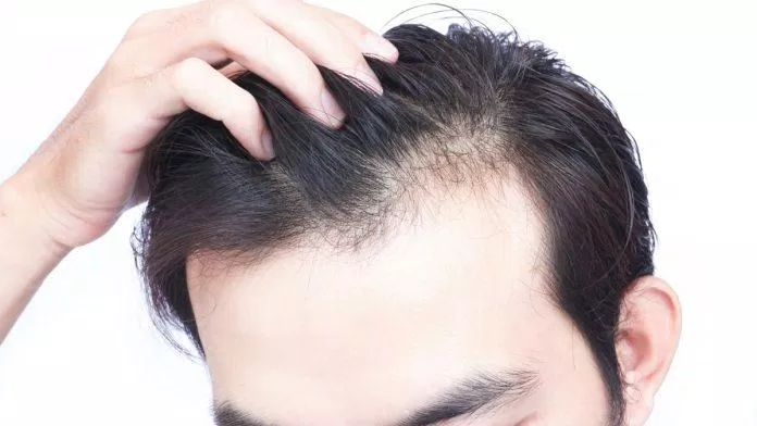 Rụng tóc cũng là một dấu hiệu của da bị stress (Ảnh: Internet)