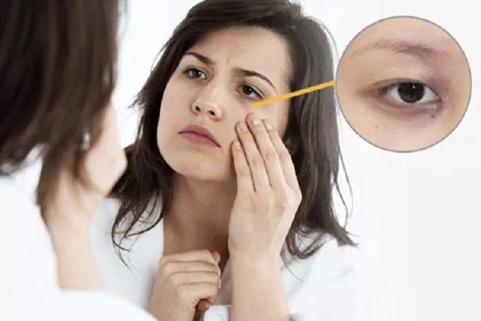 Quầng thâm mắt báo hiệu cơ thể bị stress do thiếu ngủ (Ảnh: Internet) Quầng thâm mắt báo hiệu cơ thể bị stress do thiếu ngủ (Ảnh: Internet)