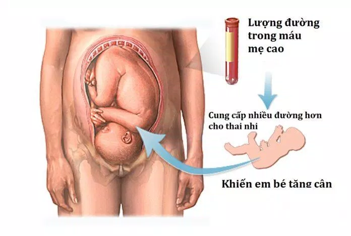 Nguyên nhân của tiểu đường thai kỳ (Ảnh: Internet)