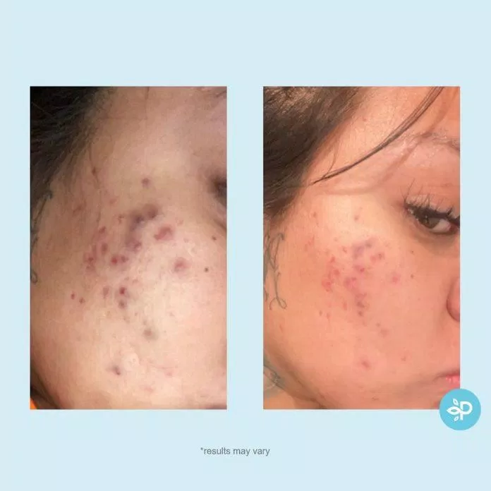 Gel Peel Salicylic