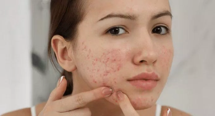 Tự ý nặn mụn khiến da thêm tổn thương
