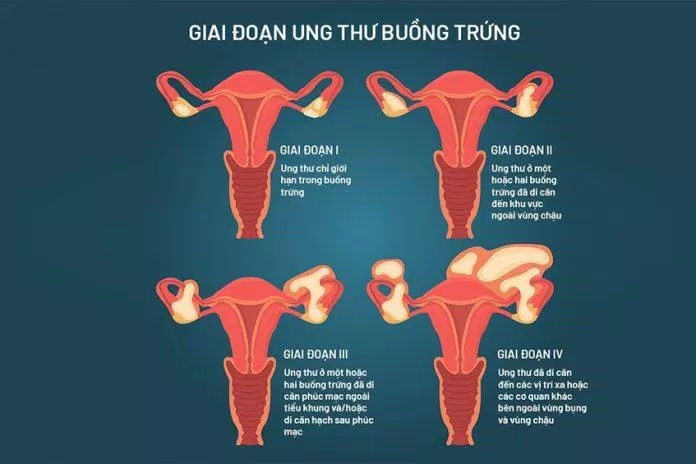 Ung thư buồng trứng: Triệu chứng, nguyên nhân, chẩn đoán và điều trị - Kiến thức mới 2024 12 Ung thư buồng trứng: Triệu chứng, nguyên nhân, chẩn đoán và điều trị ai có nguy cơ mắc ung thư buồng trứng chẩn đoán ung thư buồng trứng dấu hiệu ung thư buồng trứng điều trị ung thư buồng trứng làm thế nào để giảm nguy cơ mắc ung thư buồng trứng nguyên nhân ung thư buồng trứng triệu chứng ung thư buồng trứng ung thư buồng trứng