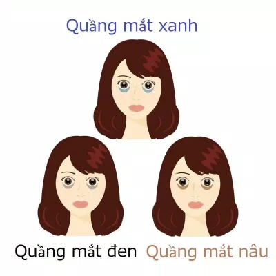 Quầng thâm mắt được chia làm ba loại khác nhau cùng các nguyên do khác nhau (Ảnh: internet)