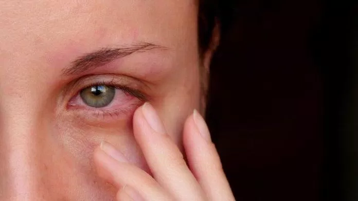 Mí mắt giật liên tục là điềm báo tốt hay xấu? (Ảnh: Internet)