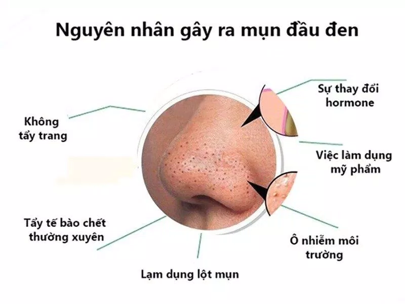 Nguyên nhân gây mụn đầu đen (Ảnh: Internet)