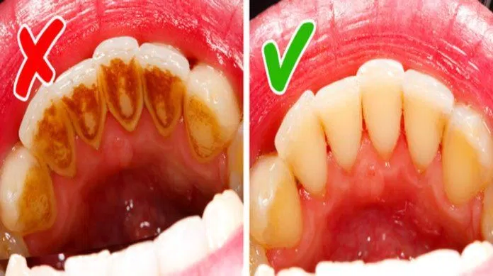 177 Khoa học đã chứng minh: Đánh răng ngay sau khi thức dậy không tốt cho răng! mới nhất