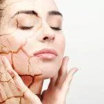 5 công thức trị mụn cho da khô tại nhà an toàn và hiệu quả