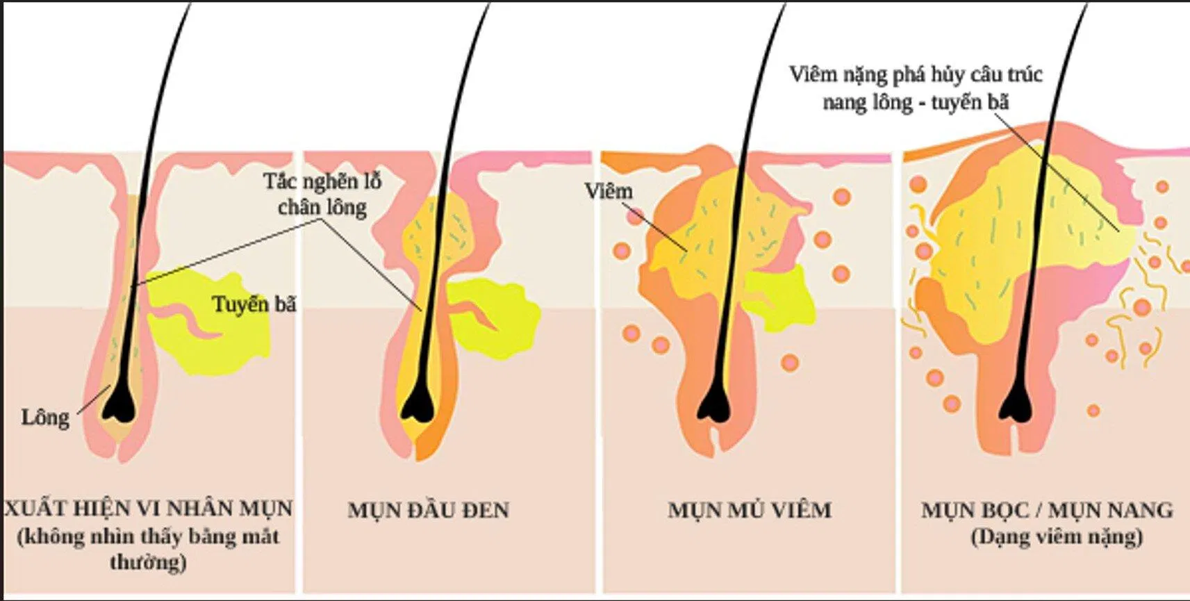 Cơ chế hình thành mụn (Ảnh: Internet). Cơ chế hình thành mụn (Ảnh: Internet).