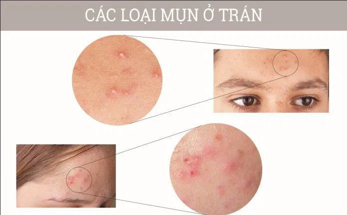 Các loại mụn mọc ở trán (Ảnh: Internet). Các loại mụn mọc ở trán (Ảnh: Internet).