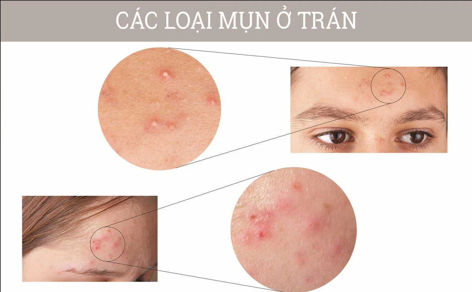 Các loại mụn mọc ở trán (Ảnh: Internet). Các loại mụn mọc ở trán (Ảnh: Internet).