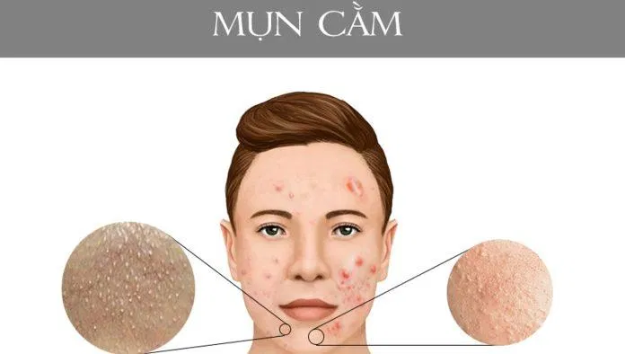 Vị trí mọc mụn ỏ cằm, các loại mụn mủ, mụn bọc, mụn ẩn... (ảnh: internet).