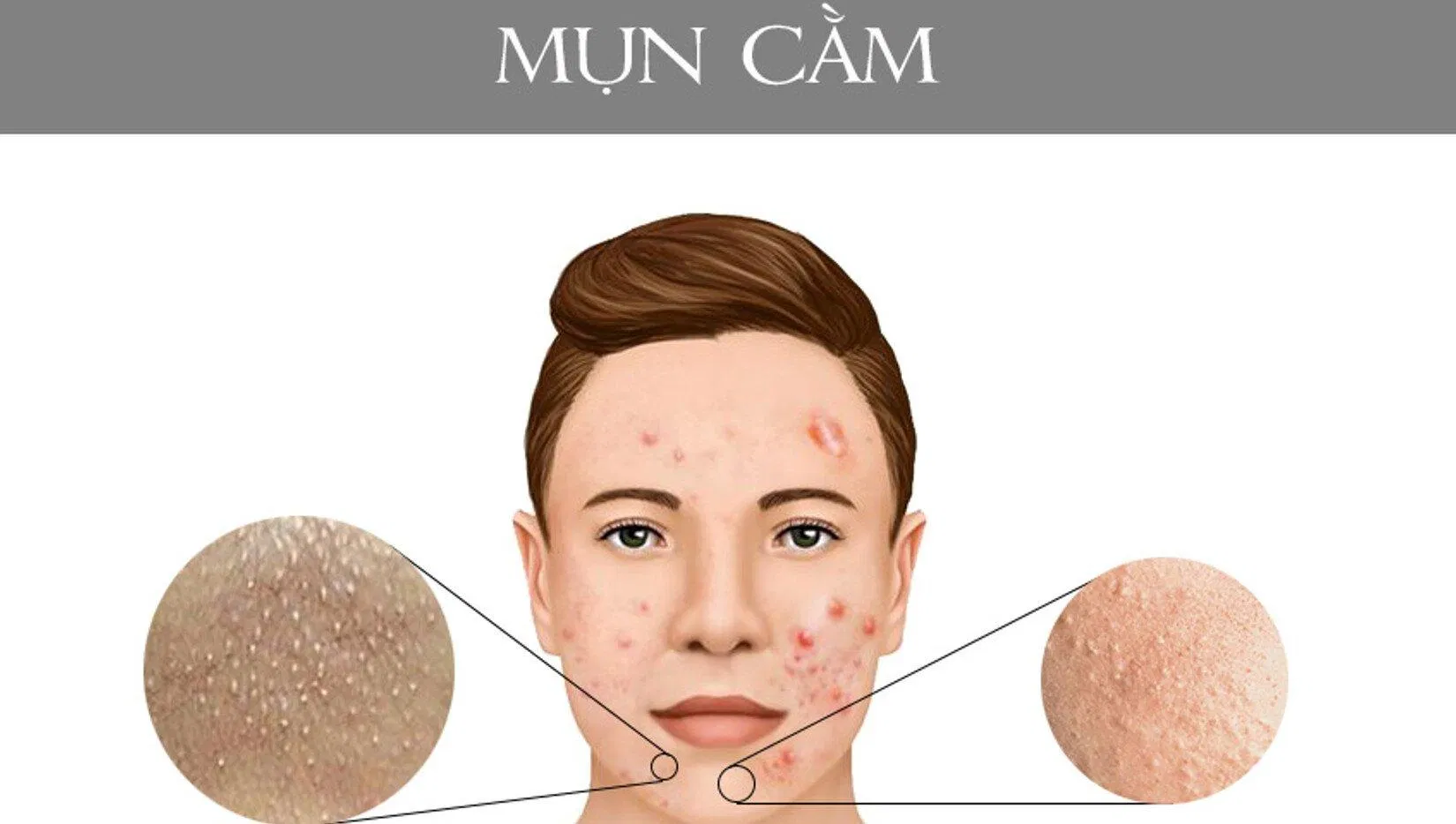 Vị trí mọc mụn ỏ cằm, các loại mụn mủ, mụn bọc, mụn ẩn... (ảnh: internet). Vị trí mọc mụn ỏ cằm, các loại mụn mủ, mụn bọc, mụn ẩn... (ảnh: internet).