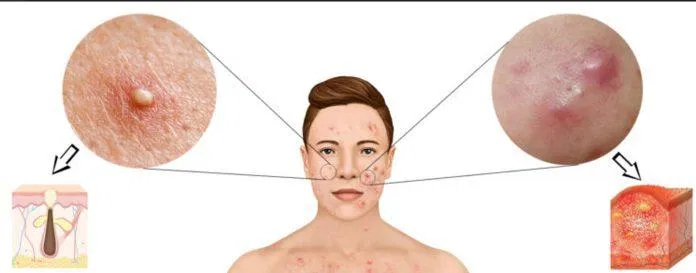 Vị trí mọc mụn trên má (ảnh: Internet).