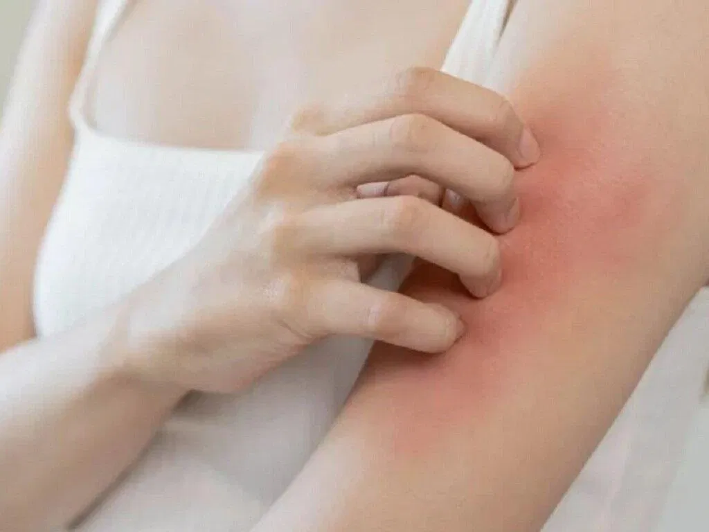 Ngứa da thường xuyên có thể báo hiệu gan bị nhiễm mỡ (Ảnh: Internet)