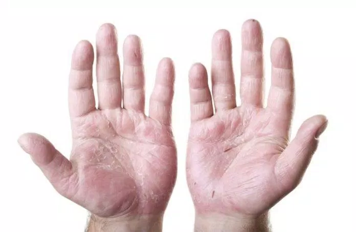 Tránh hiện tượng da tay bị nứt bằng cách dùng kem dưỡng ẩm, hạn chế tiếp xúc nước (nguồn: internet)
