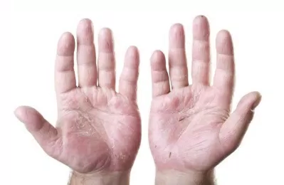 Tránh hiện tượng da tay bị nứt bằng cách dùng kem dưỡng ẩm, hạn chế tiếp xúc nước (nguồn: internet)